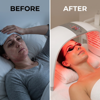 Luxora Red Light Therapy Dome Pro — Before & After